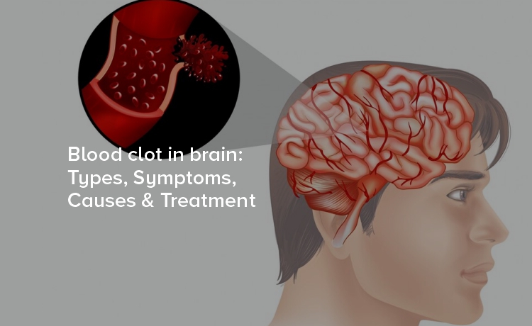 Blood clot in brain: Types, Symptoms, Causes & Treatment