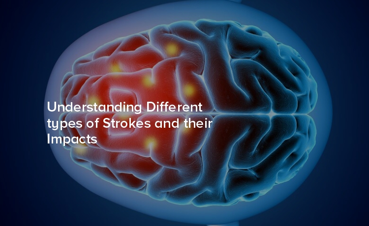 Understanding Different Types of Strokes and Their Impacts