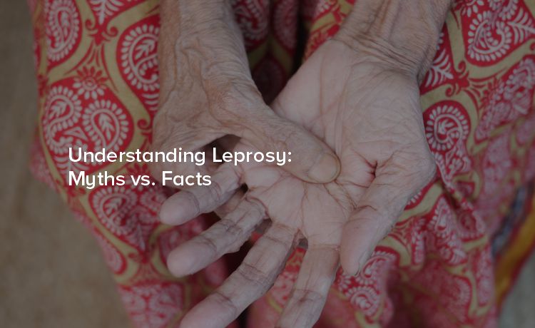 Understanding Leprosy: Myths vs. Facts