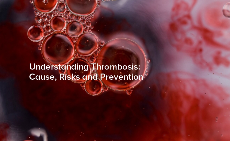 Understanding Thrombosis: Causes, Risks, and Prevention